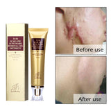 Acne Scar Remover Cream