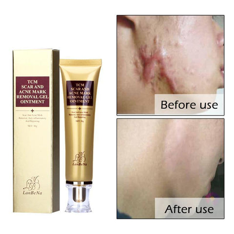 Acne Scar Remover Cream