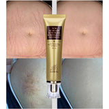 Acne Scar Remover Cream