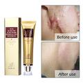 Acne Scar Remover Cream